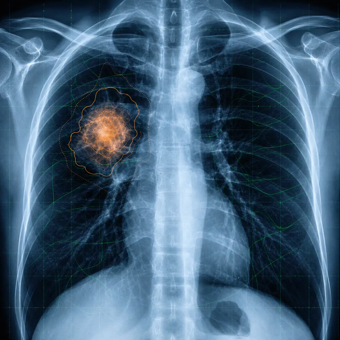 Chest X-ray with a highlighted lung region and diagnostic grid.